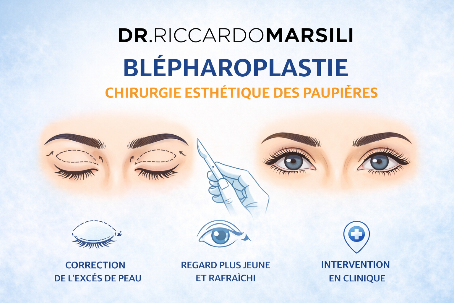 Faire une blépharoplastie sur Paris 16