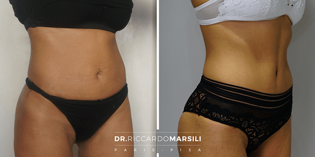 Faire son abdominoplastie à Paris après une grossesse