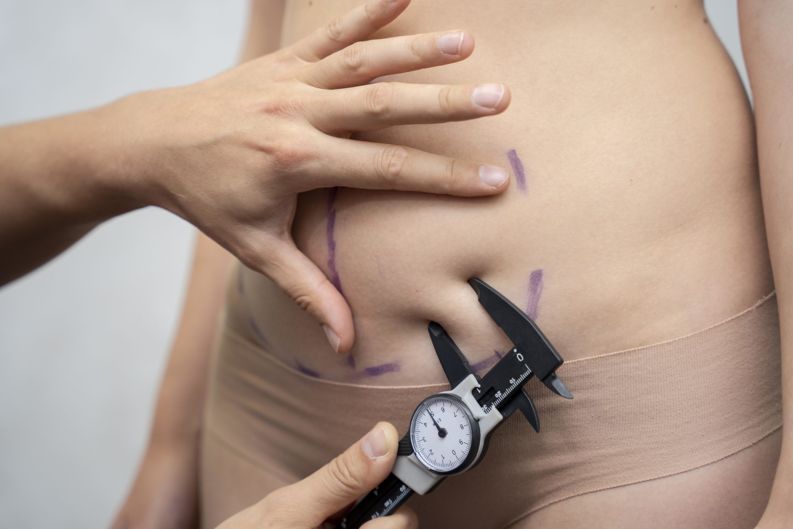 Le pannicule abdominal